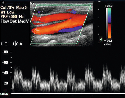 The Carotid and Vertebral Arteries; Transcranial Colour Doppler ...