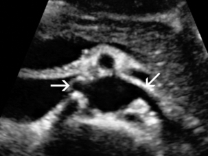 renal artery anatomy ultrasound