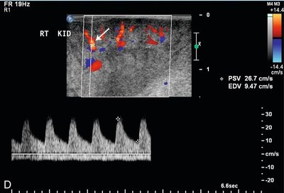 Interventional And Intraoperative Doppler | Radiology Key