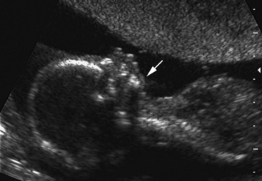 THE SECOND TRIMESTER GENETIC SONOGRAM | Radiology Key