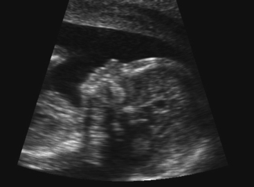 Down Syndrome Ultrasound Nasal Bone