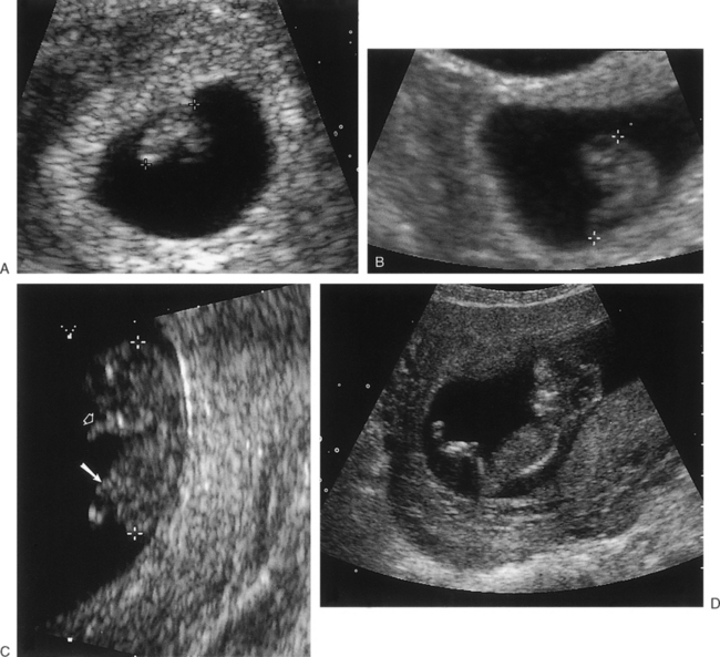 ULTRASOUND EVALUATION DURING THE FIRST TRIMESTER OF PREGNANCY ...