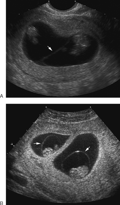 For twins ultrasound How early