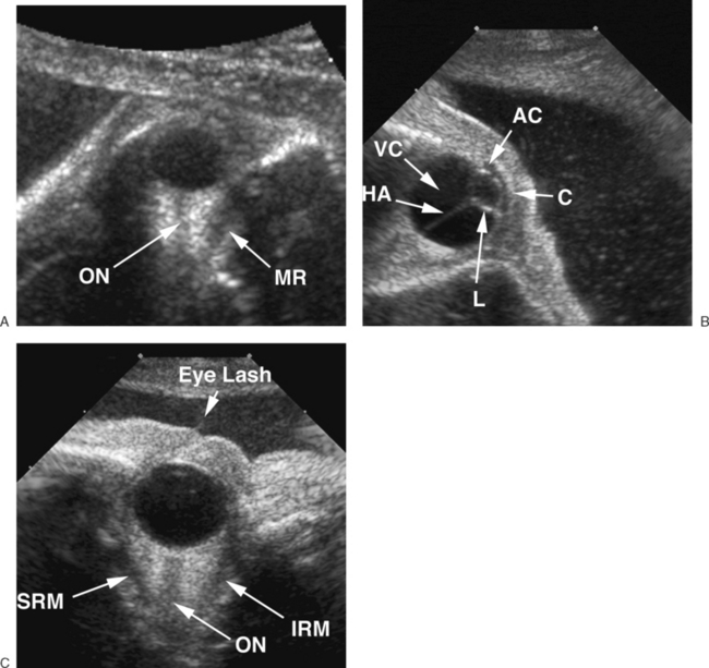 ULTRASOUND EVALUATION OF NORMAL FETAL ANATOMY | Radiology Key