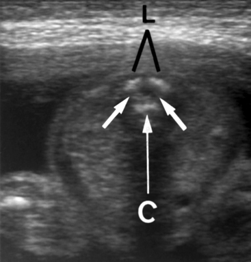 Fetal Spine Anatomy Ultrasound