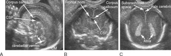 Abnormal Fetal Head Ultrasound 