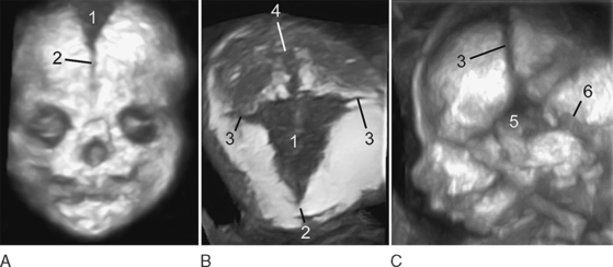 ULTRASOUND EVALUATION OF THE FETAL FACE AND NECK Radiology Key