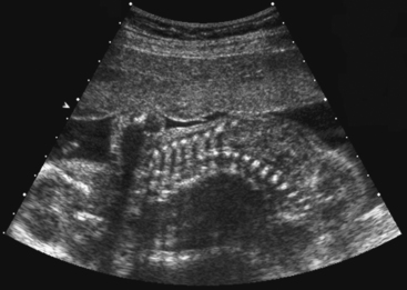 THE FETAL MUSCULOSKELETAL SYSTEM | Radiology Key