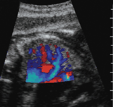 ULTRASOUND EVALUATION OF THE FETAL THORAX | Radiology Key