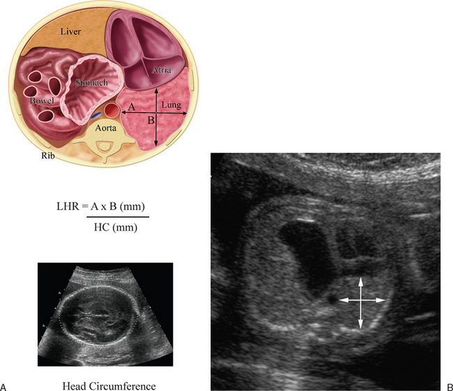 ULTRASOUND EVALUATION OF THE FETAL THORAX | Radiology Key