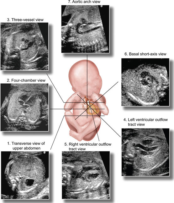  Heart Problems In Fetal Ultrasound Ababyw