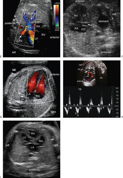 ULTRASOUND EVALUATION OF THE FETAL HEART | Radiology Key