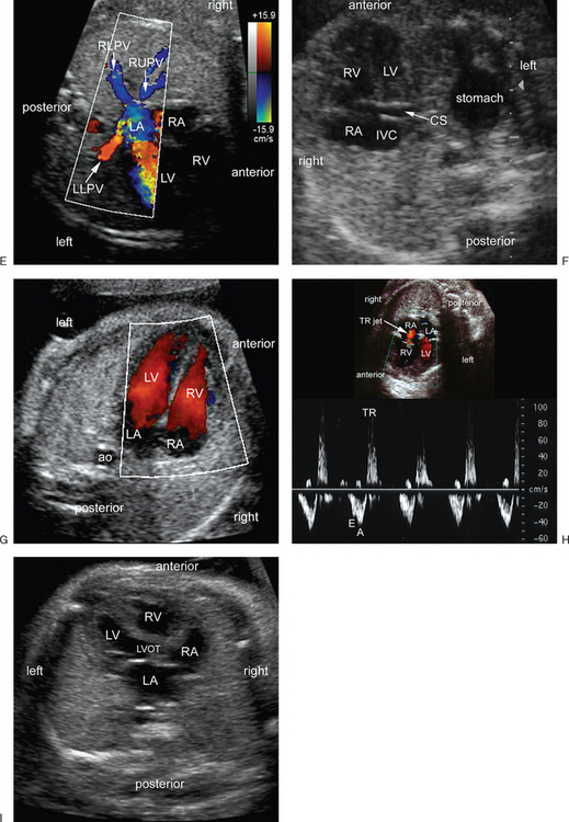 Fetal Heart Anomalies Ultrasound