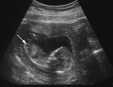 THE FETAL GENITOURINARY TRACT | Radiology Key