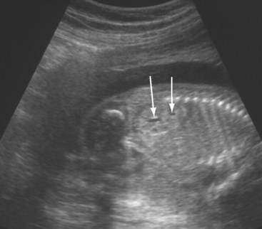 THE FETAL GENITOURINARY TRACT | Radiology Key