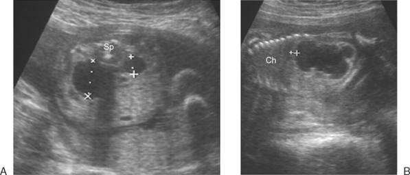 THE FETAL GENITOURINARY TRACT | Radiology Key