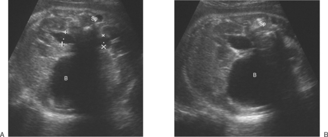 THE FETAL GENITOURINARY TRACT | Radiology Key