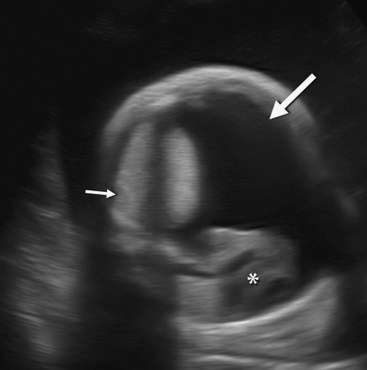 ULTRASOUND EVALUATION OF HYDROPS FETALIS | Radiology Key