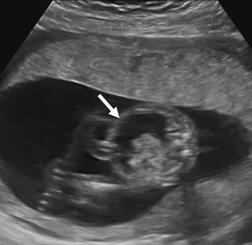 ULTRASOUND EVALUATION OF HYDROPS FETALIS | Radiology Key