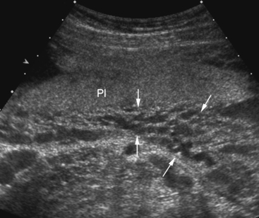 ULTRASOUND EVALUATION OF THE PLACENTA AND UMBILICAL CORD ...