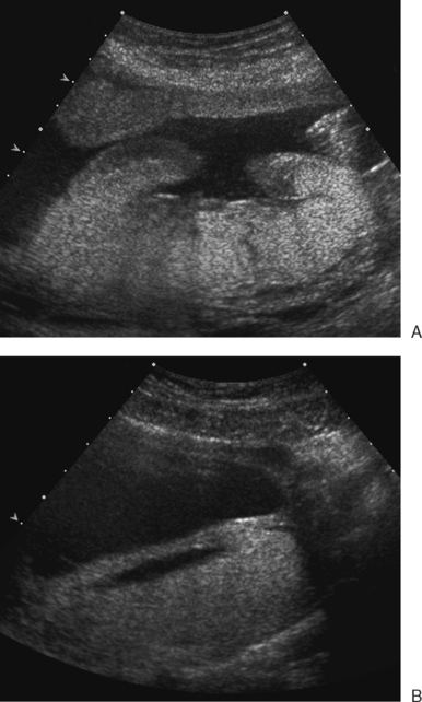 ULTRASOUND EVALUATION OF THE PLACENTA AND UMBILICAL CORD | Radiology Key