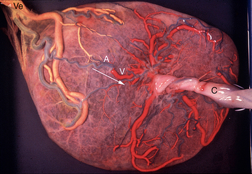 Ultrasound Evaluation Of The Placenta And Umbilical Cord Radiology Key