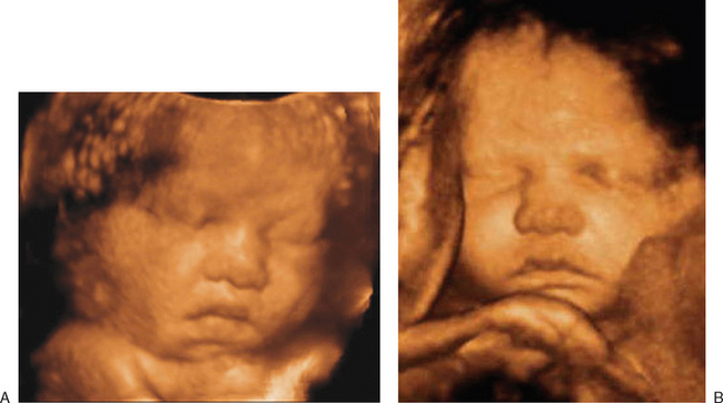 THE ROLE OF THREE-DIMENSIONAL ULTRASOUND IN THE EVALUATION OF THE FETUS ...