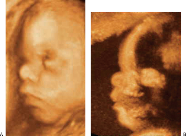 The Role Of Three Dimensional Ultrasound In The Evaluation Of The Fetus Radiology Key