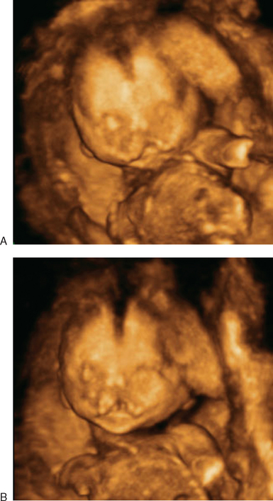 The Role Of Three Dimensional Ultrasound In The Evaluation Of The Fetus Radiology Key