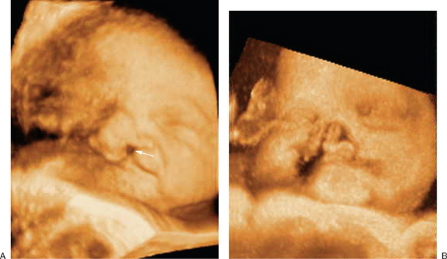 The Role Of Three Dimensional Ultrasound In The Evaluation Of The Fetus Radiology Key