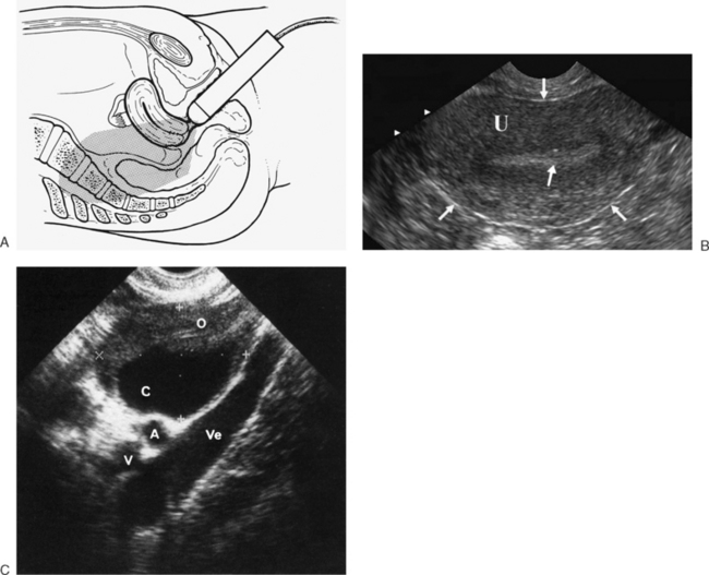 Transvaginal Ultrasound Diagram My Xxx Hot Girl