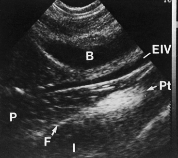 NORMAL ANATOMY OF THE FEMALE PELVIS AND TRANSVAGINAL SONOGRAPHY ...