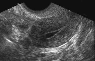 ABNORMAL UTERINE BLEEDING: THE ROLE OF ULTRASOUND | Radiology Key