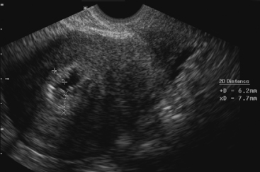 ABNORMAL UTERINE BLEEDING: THE ROLE OF ULTRASOUND | Radiology Key