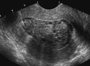 ABNORMAL UTERINE BLEEDING: THE ROLE OF ULTRASOUND | Radiology Key