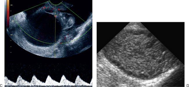 ULTRASOUND EVALUATION OF THE UTERUS | Radiology Key