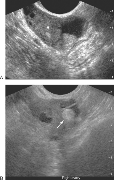 ULTRASONOGRAPHIC IMAGING IN INFERTILITY | Radiology Key