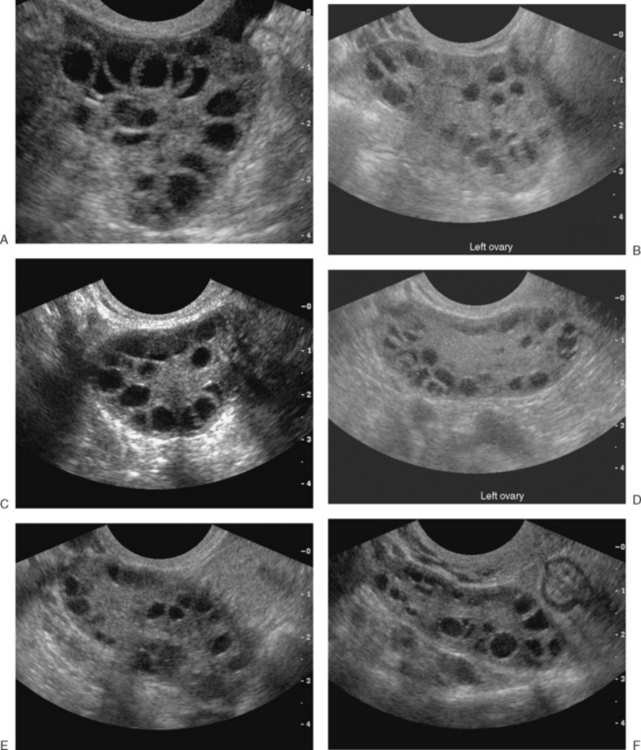 Normal Vs Polycystic Ovaries Ultrasound