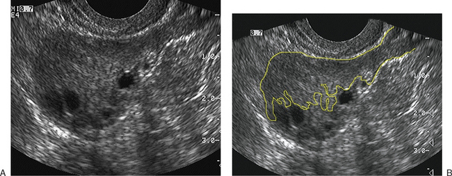 ULTRASONOGRAPHIC IMAGING IN INFERTILITY | Radiology Key