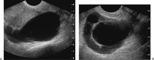 ULTRASONOGRAPHIC IMAGING IN INFERTILITY | Radiology Key