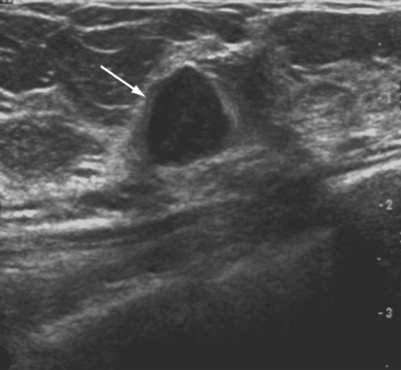 ULTRASOUND OF THE BREAST | Radiology Key