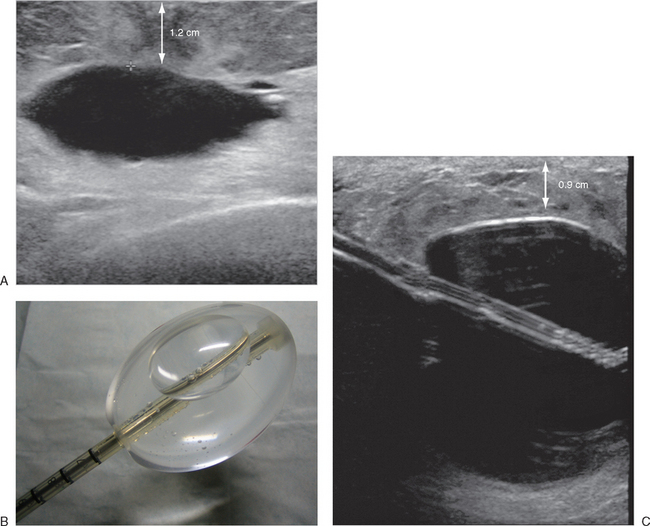 ULTRASOUND OF THE BREAST | Radiology Key