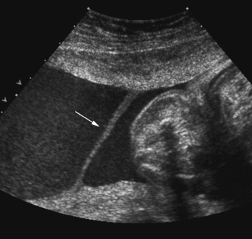 ARTIFACTS, PITFALLS, AND NORMAL VARIANTS | Radiology Key