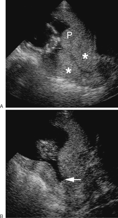 ARTIFACTS, PITFALLS, AND NORMAL VARIANTS | Radiology Key