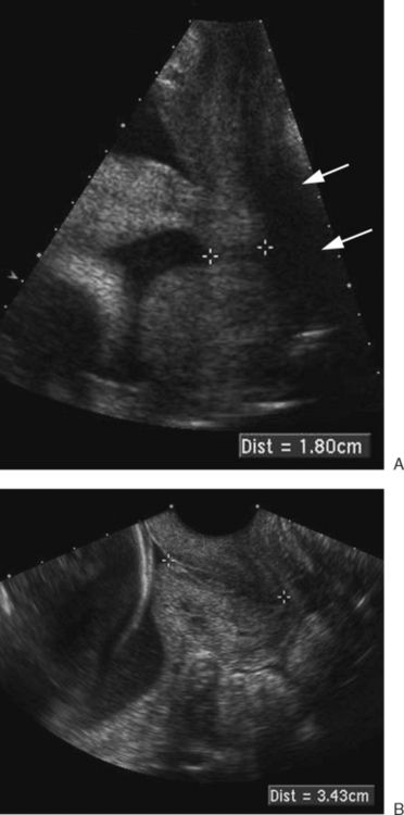 ARTIFACTS, PITFALLS, AND NORMAL VARIANTS | Radiology Key