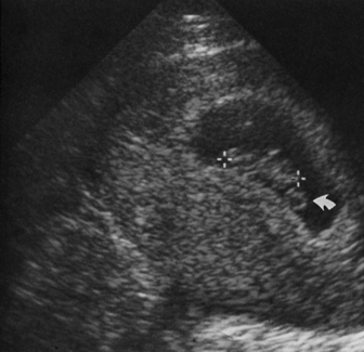 ARTIFACTS, PITFALLS, AND NORMAL VARIANTS | Radiology Key