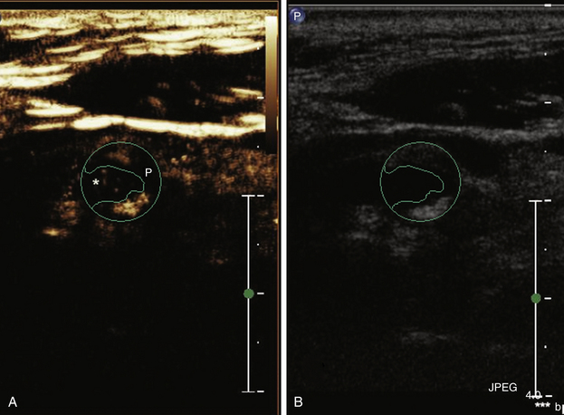 Ultrasound Assessment Of Carotid Plaque Radiology Key