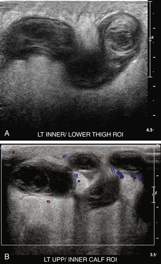 Cruz Rvt Ultrasound Diagnosis of Lower Extremity Venous Thrombosis | Radiology Key