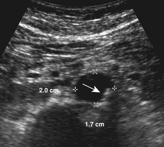 ultrasound diagnostics of the abdominal aorta