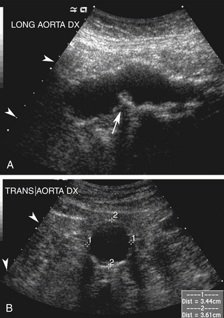 Ultrasound Assessment Of The Abdominal Aorta Radiology Key